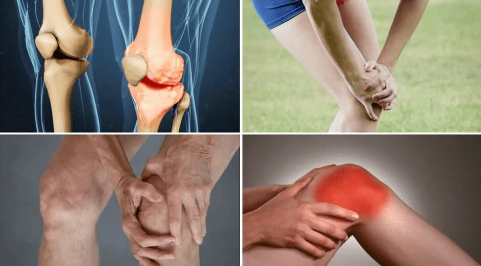 أعراض التهاب المفاصل